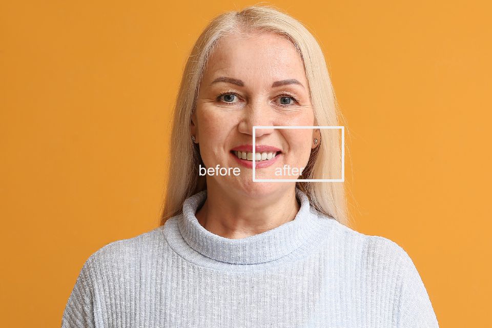 Alternatives To Dental Veneers