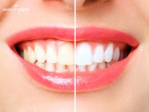 Teeth Whitening