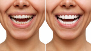 before and after veneers